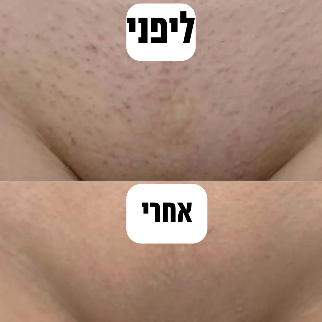 Glorace™ - מכשיר להסרת שיער