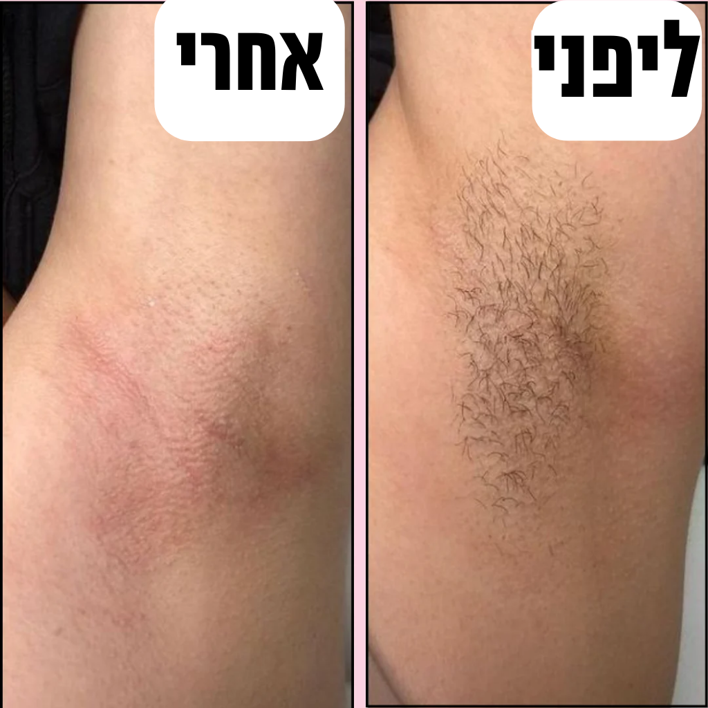 Glorace™ - מכשיר להסרת שיער