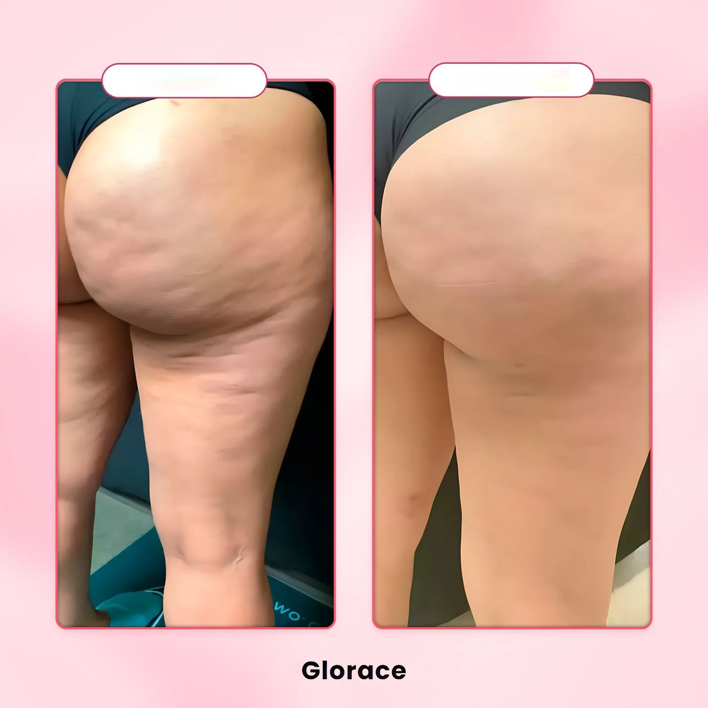 Glorace™ ערכה טיפולית לצלוליטיס