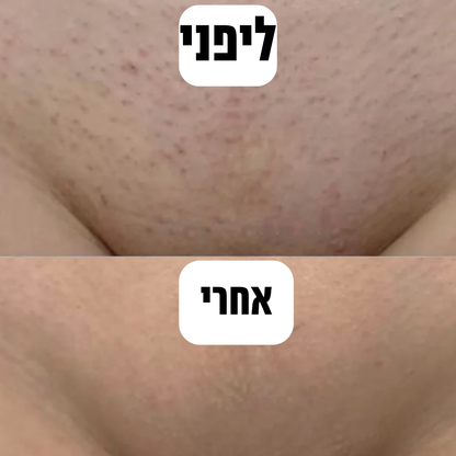 Glorace™ - מכשיר להסרת שיער